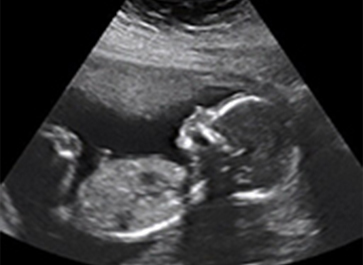 Gender Ultrasound